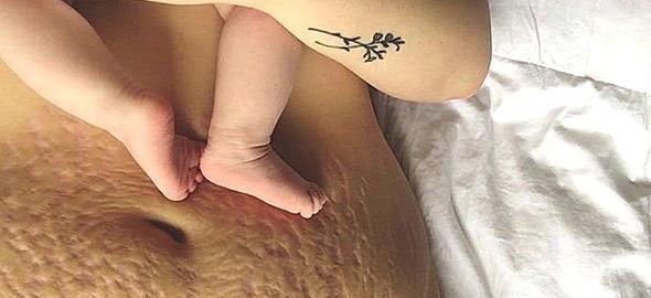 Πώς είναι το σώμα της γυναίκας μετά την εγκυμοσύνη: 11 ρεαλιστικές φωτογραφίες